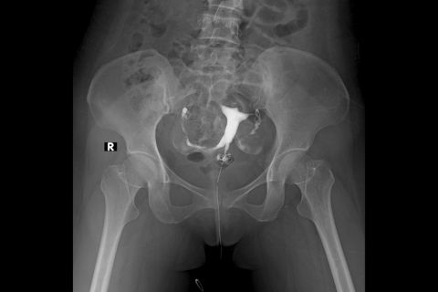 Hysterosalpingography (HSG)