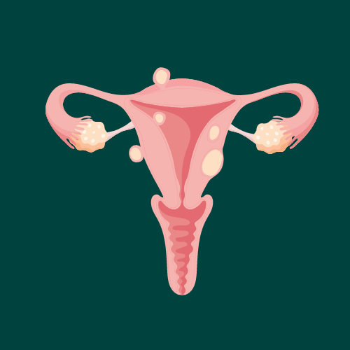 Fibroids
